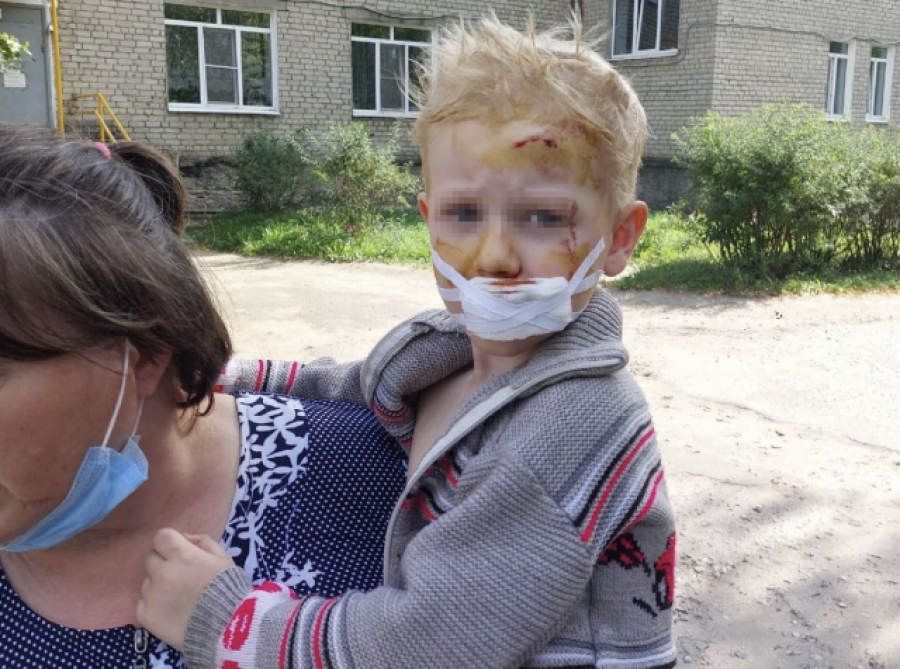 В Костромской области собака порвала лицо 3-летнему ребенку