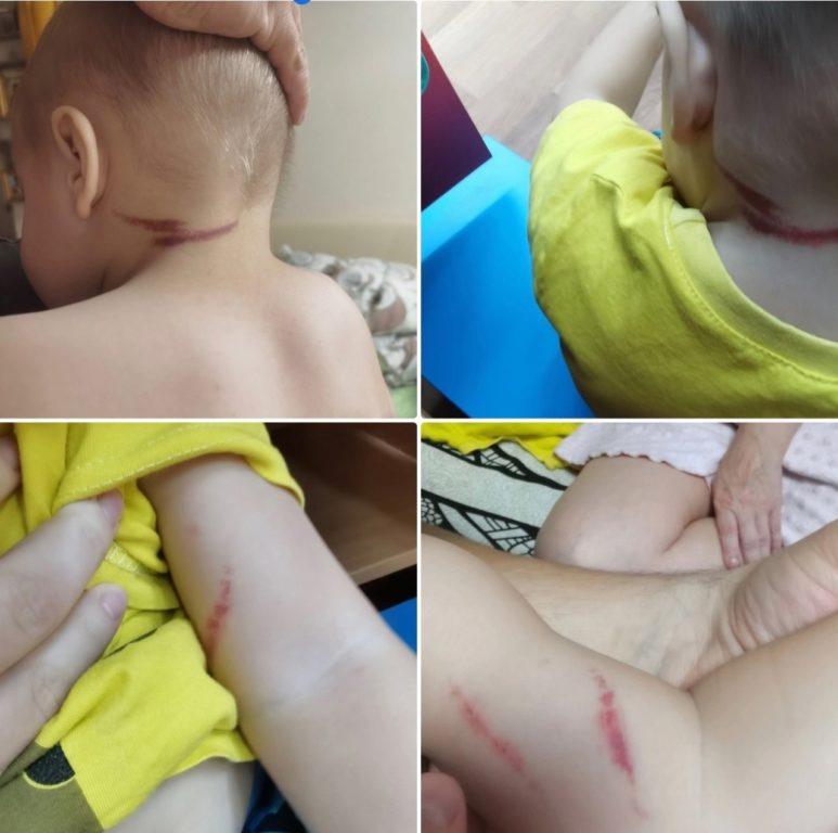 В Костроме 2-летний малыш пришел из детского сада с ссадинами на руках и шее